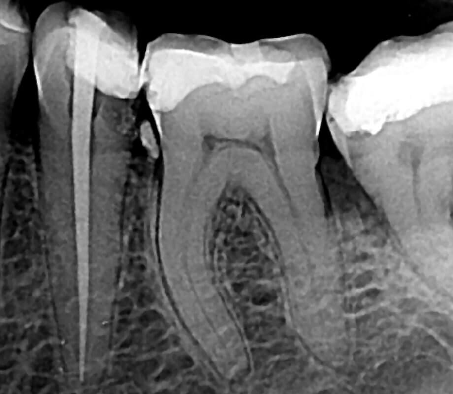 Root canal treatment