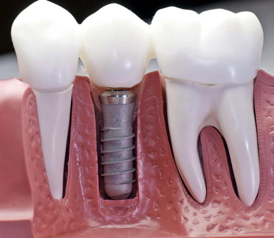 Dental Implants