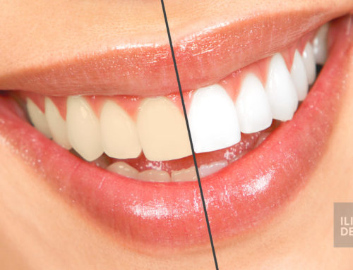 Šta je to beljenje zuba?