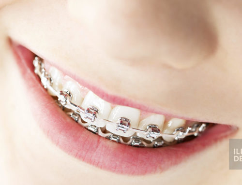 Orthodontic appliances and fixed braces